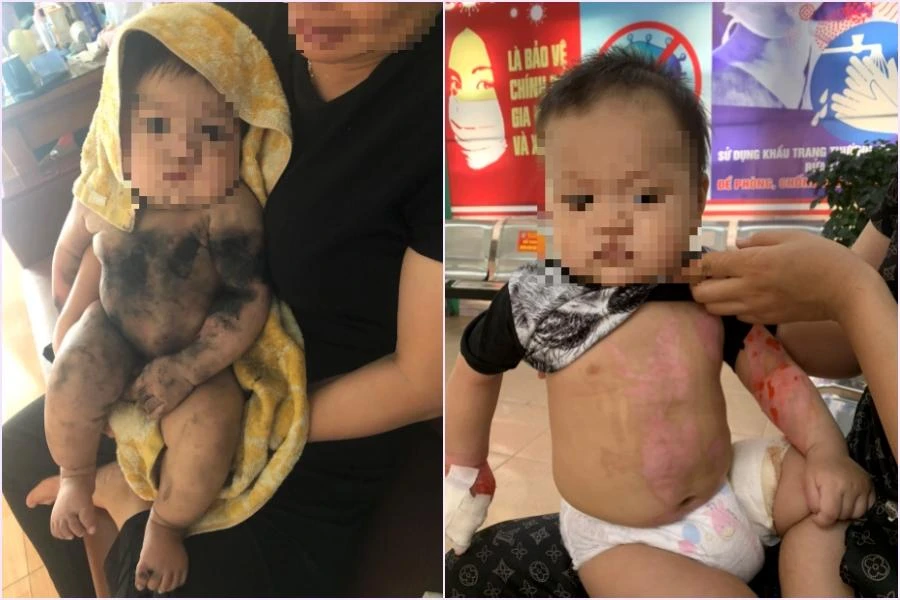 Hình ảnh bé K trước khi đến viện (trái) và sau khi được điều trị tại bệnh viện. Ảnh: BVCC