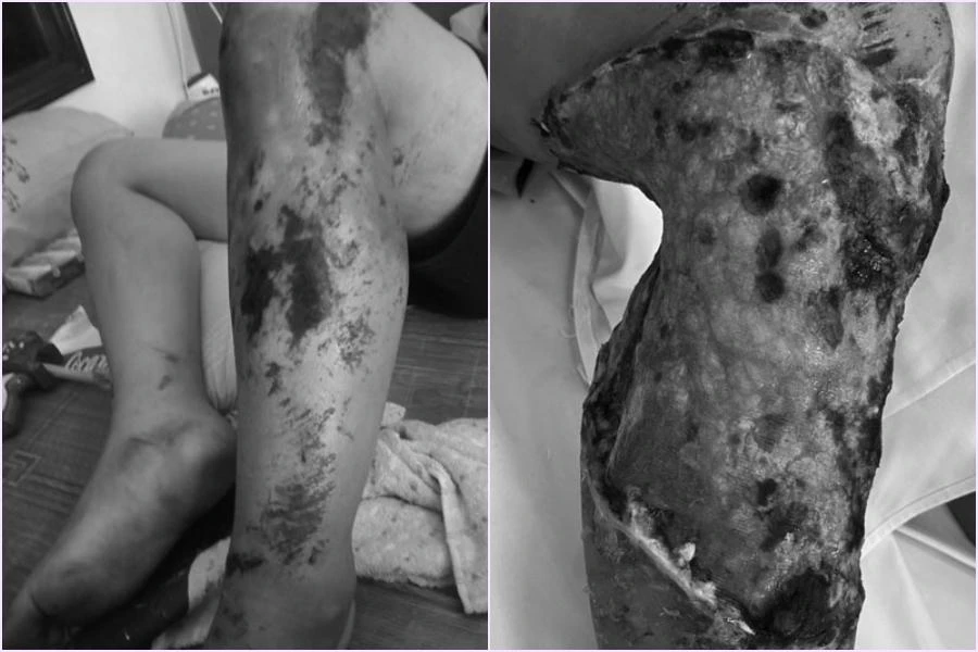 Chấn thương của bệnh nhi trước và sau khi đắp lá thuốc. Ảnh: BV Chấn thương của bệnh nhi trước và sau khi đắp lá thuốc. Ảnh: BV