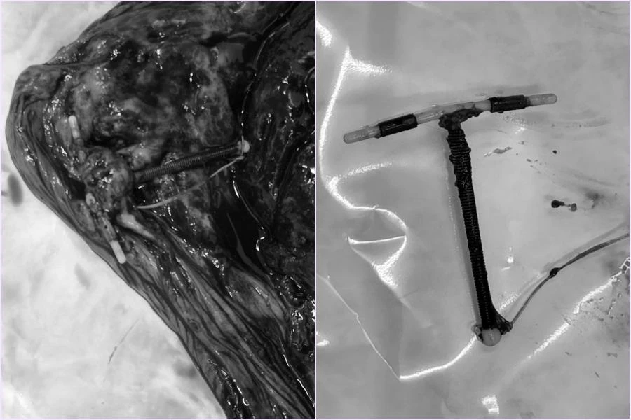 Hình ảnh vòng tránh thai nằm sát rìa bánh nhau ở mặt tử cung của mẹ. Ảnh: BSCC Hình ảnh vòng tránh thai nằm sát rìa bánh nhau ở mặt tử cung của mẹ. Ảnh: BSCC