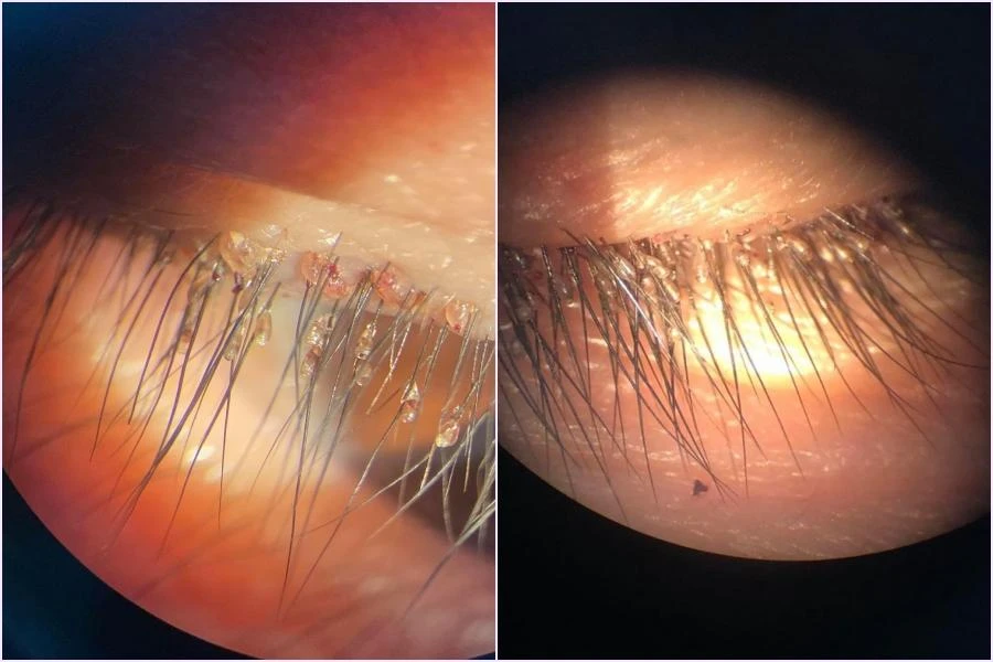 Bệnh nhân được kiểm tra mắt dưới kính hiển vi và “tá hoả” khi phát hiện hàng trăm ký sinh trùng và trứng ký sinh trên mi mắt. Ảnh: BV