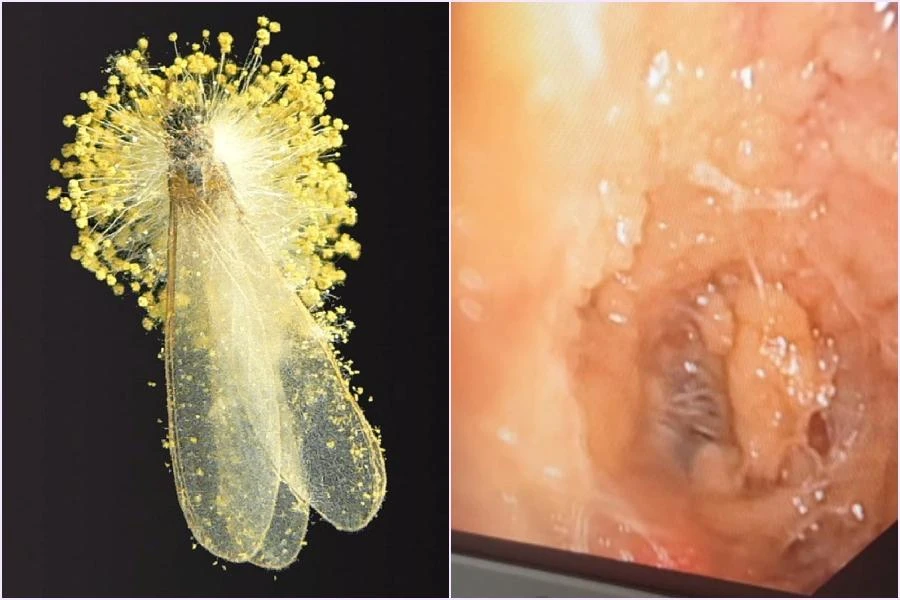 Hình ảnh nấm Aspegillus fumigatus ký sinh trên mối và hình ảnh nội soi phế quản: giả mạc lan rộng toàn bộ niêm mạc đường thở và giả mạc tập trung như mạng nhện lấp kín phế quản. Ảnh: BV