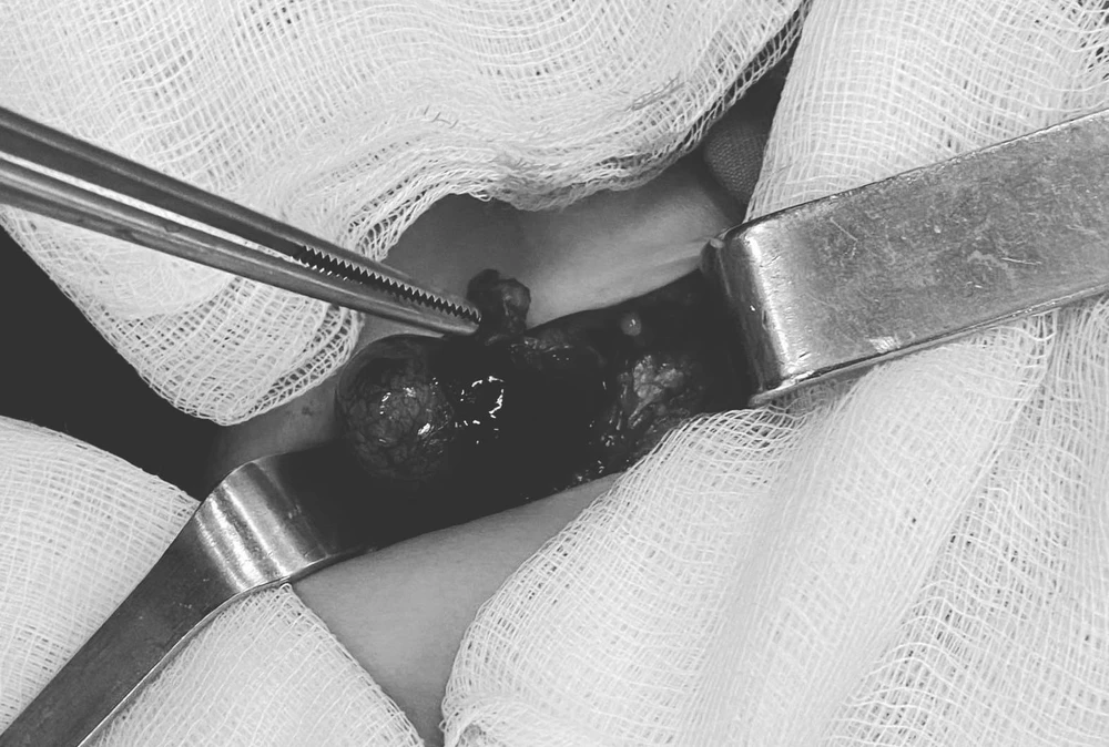 Hình ảnh xoắn tinh hoàn ở bệnh nhi 10 tháng tuổi. Ảnh: BV