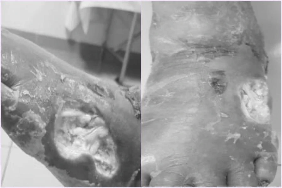 Người bệnh được nhập viện điều trị với chẩn đoán loét hoại tử bàn chân trái. Ảnh: BV