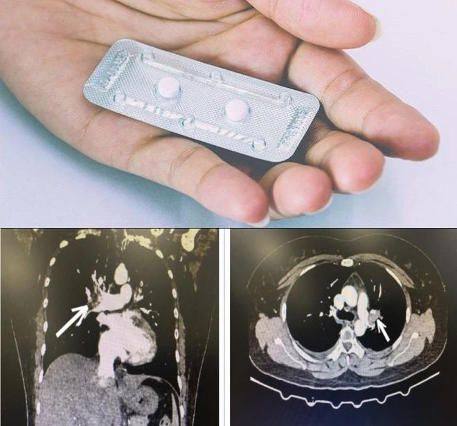 Một số phụ nữ được khuyên không nên sử dụng thuốc tránh thai nếu có nguy cơ đột quỵ, đau tim, hình thành cục máu đông hoặc các vấn đề khác về tim mạch.