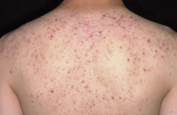 Khoảng 30 phút bôi thuốc tê, người phụ nữ xuất hiện đỏ toàn thân, ngứa, khó thở và rối loạn ý thức.