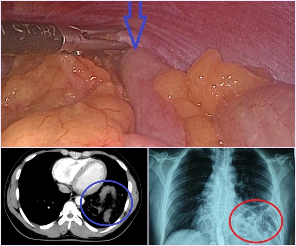 Hình ảnh đại tràng chui lên khoang phổi của nam thanh niên.