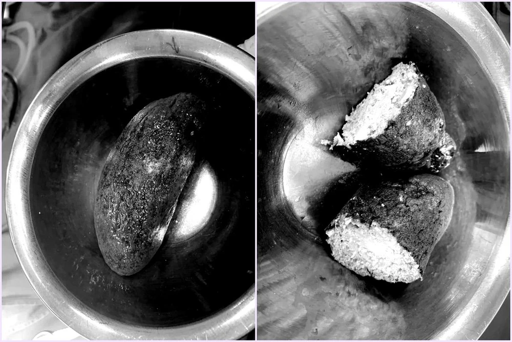 Khối bã thức ăn lớn trong dạ dày bệnh nhân được bác sĩ lấy ra ngoài. Ảnh: BSCC