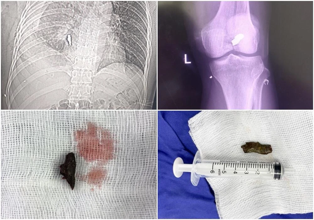 Các dị vật trong ngực và đầu gối của bệnh nhân được kíp cấp cứu phẫu thuật lấy ra thành công.