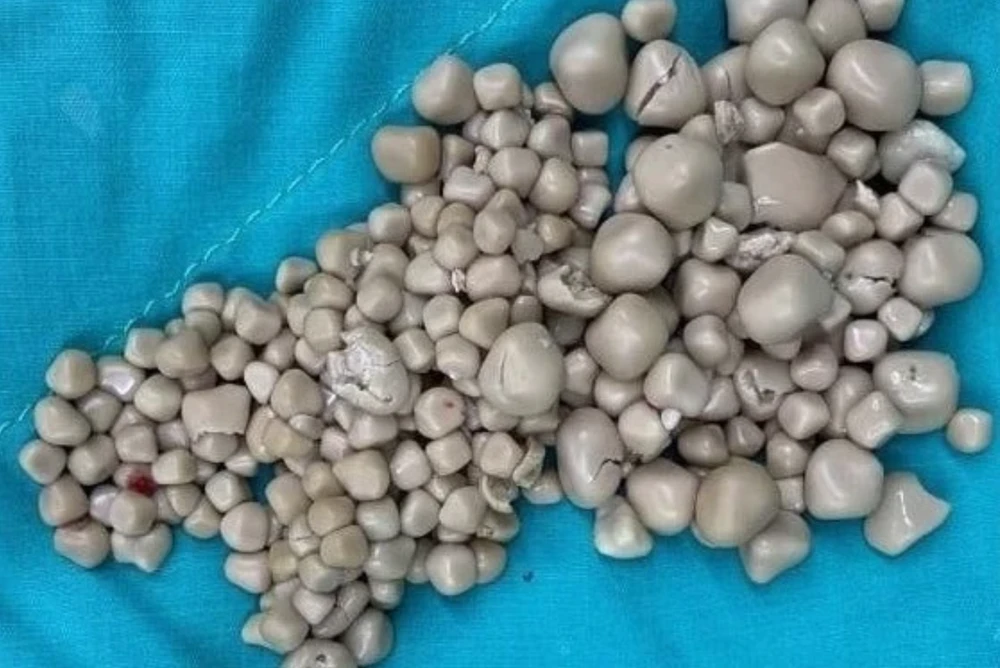 300 viên sỏi thận