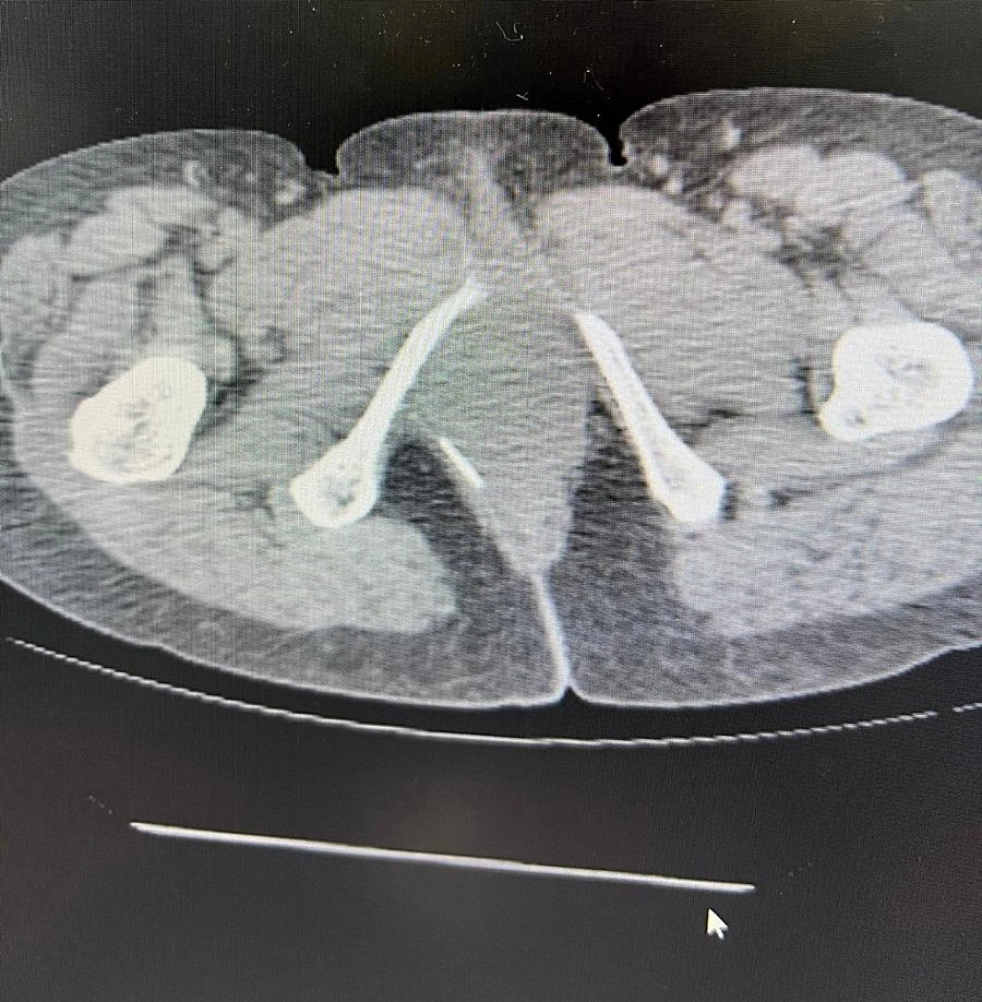 Ảnh chụp cắt lớp vi tính và đoạn tăm tre dài.