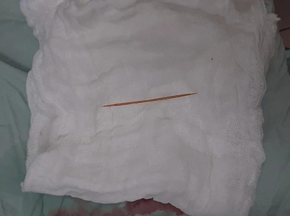 Dị vật được các bác sĩ lấy ra.