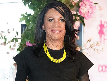 Cô đã phải đeo “mạng che mặt” trong 2 năm và gần đây đã không ngại bỏ ra.&nbsp;