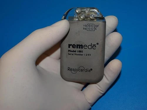 Thí nghiệm cho thấy thiết bị cấy dưới da trị ngưng thở lúc ngủ đạt hiệu quả bước đầu Ảnh: MNT