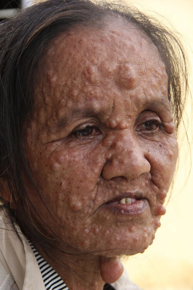 Người phụ nữ với những khối u ảnh 1