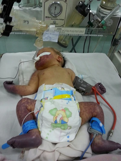 Cứu sống bệnh nhi sơ sinh bị tắc mạch tứ chi ảnh 1