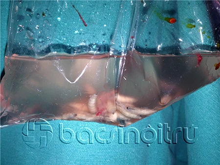 Hiếm gặp: Giòi lúc nhúc trong đầu bệnh nhân ảnh 1