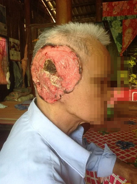 Thêm một trường hợp bị bệnh lạ “ăn” mất tai ảnh 1