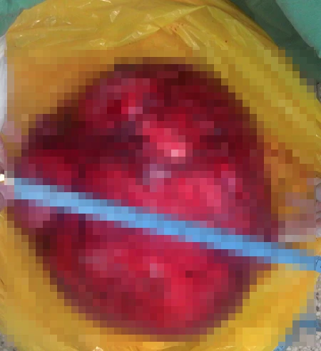 BV Nhân dân Gia Định phẫu thuật lấy khối u xơ tử cung 12,5 kg ảnh 1