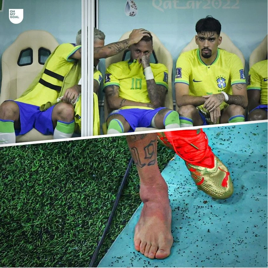 Hình ảnh mắt cá chân sưng tấy của Neymar sau trận đấu. Ảnh: GOAL