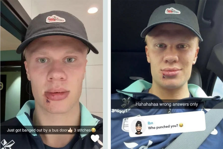 Haaland đập mặt vào cửa kính phải khâu 3 mũi,HAALAND