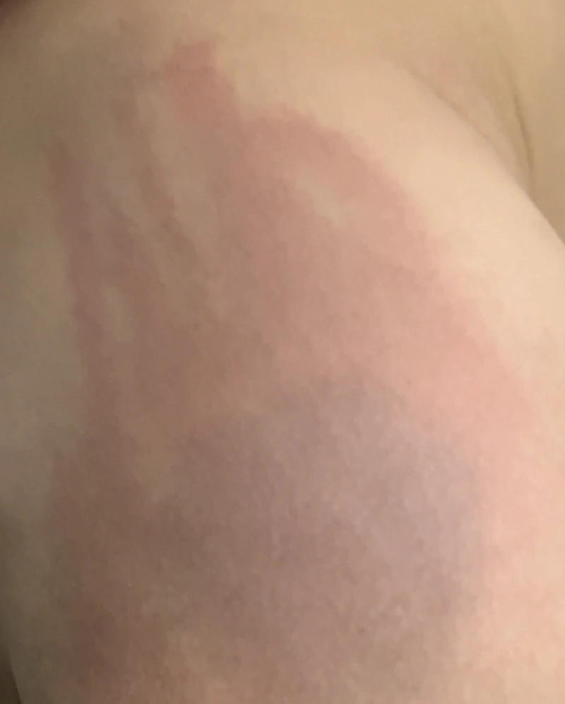 trẻ bị nhiều vết đỏ ở mông