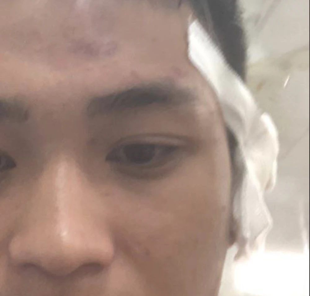 Anh Phạm Gia Q bị các cầu thủ bị các cầu thủ đội bạn hành hung, cắn rách tai tại sân 79. Ảnh: TS