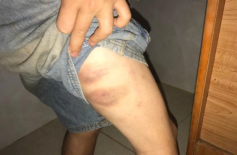 Cháu A. có nhiều thương tích trên cơ thể. Ảnh do gia đình cung cấp