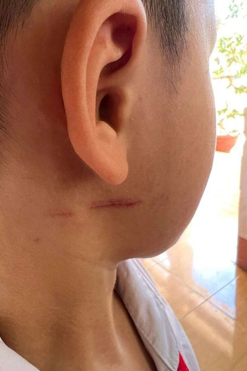 Cháu A. bị đánh nhiều nơi trên cơ thể. Ảnh do gia đình cung cấp