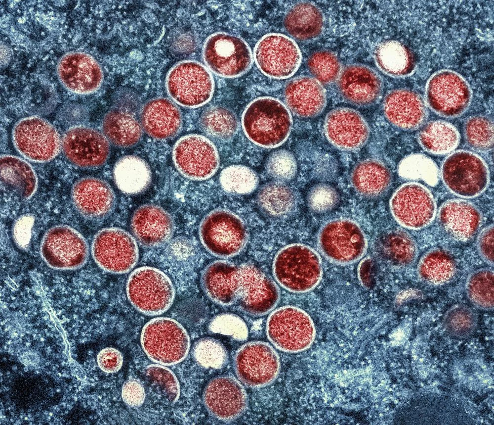 Hình ảnh hiển vi điện tử của virus “đậu mùa khỉ” hay “mpox”. Ảnh: AP