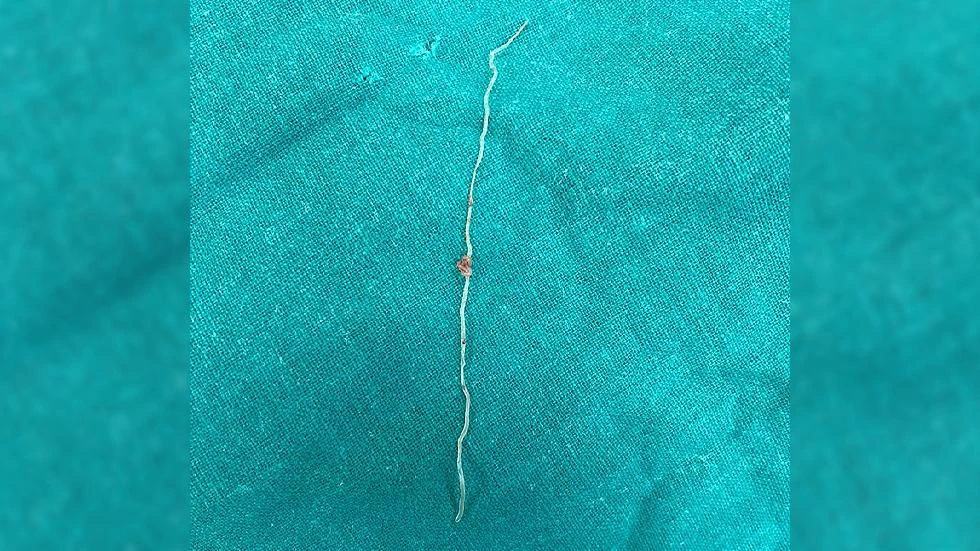 Các bác sĩ cho biết con giun được gắp ra từ má của người phụ nữ dài 12 cm. Ảnh: RT.