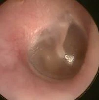 Viêm tai ngoài ảnh 2