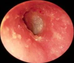 Viêm tai ngoài ảnh 3