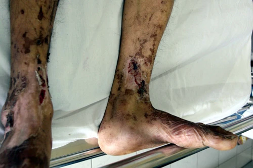 Mất mạng do ăn tái, sống ảnh 1 Mất mạng do ăn tái, sống 2