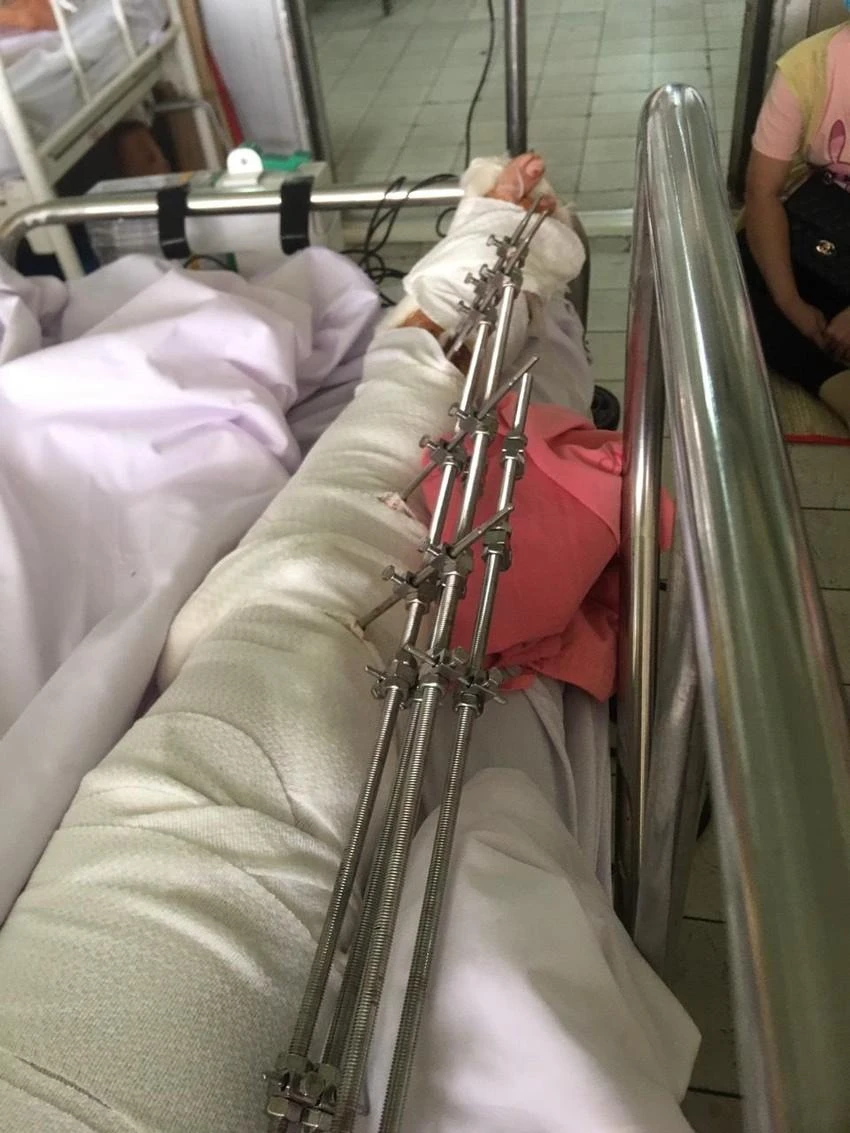 Chân bà H gãy hở nhiều chỗ, bàn chân phải bị dập nát, đa chấn thương. Ảnh: NVCC