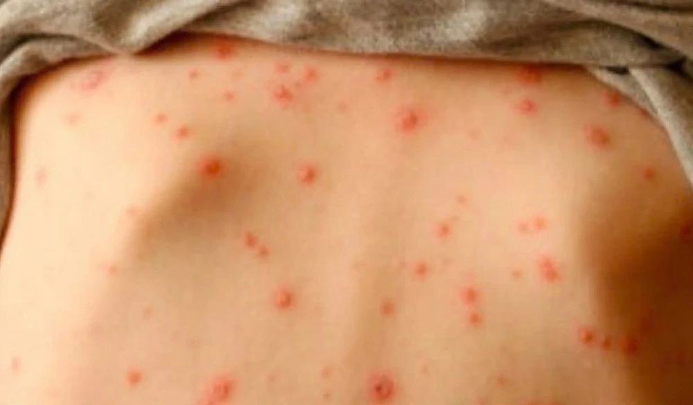 Ghi nhận 83 ca mắc thủy đậu tại công ty may mặc trong KCN Giao Long