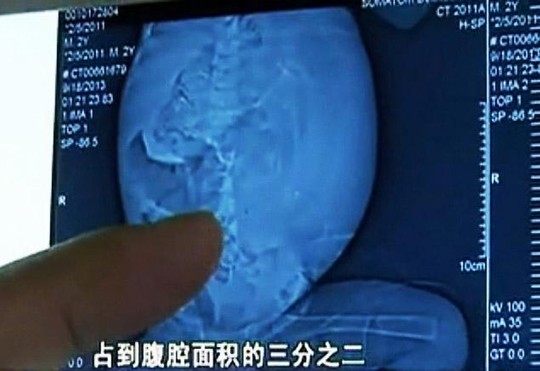 Thai nhi trong bụng Xiao đã hình thành xương sống và tay chân. Ảnh: v.youku.com Thai nhi trong bụng Xiao đã hình thành xương sống và tay chân. Ảnh: v.youku.com
