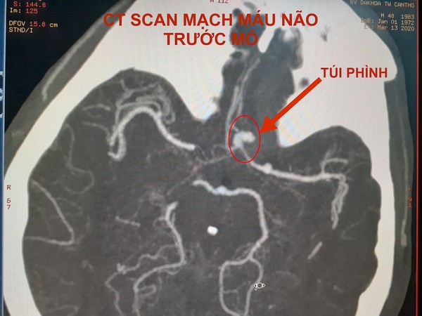 Hình ảnh CT Scan mạch máu não trước và sau vi phẫu kẹp túi phình. Ảnh: HẢI DƯƠNG 1
