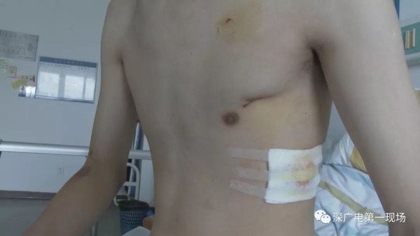 Tập thể dục cũng gây tràn khí màng phổi