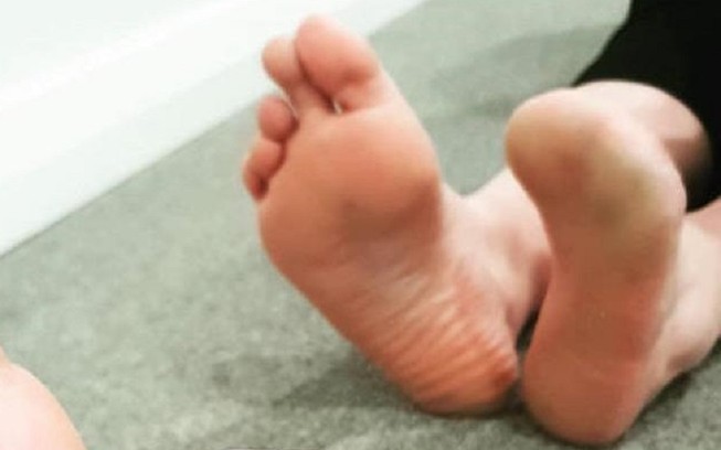 Mất hết 5 ngón chân vì đi massage cá