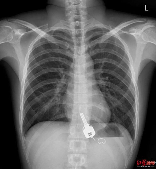 Nhậu xỉn, chàng trai nuốt luôn chìa khóa nhà