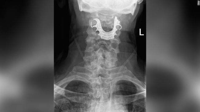 Bác sĩ làm rơi răng giả trong bụng cụ ông 72 tuổi suốt 8 ngày
