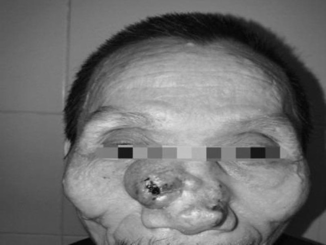 Tái tạo lại mũi, má cho bệnh nhân mắc bệnh ung thư