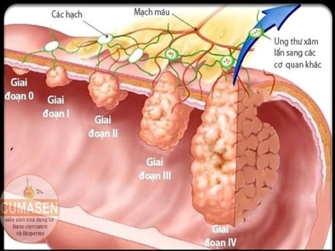 6 triệu chứng thầm lặng của ung thư đại tràng