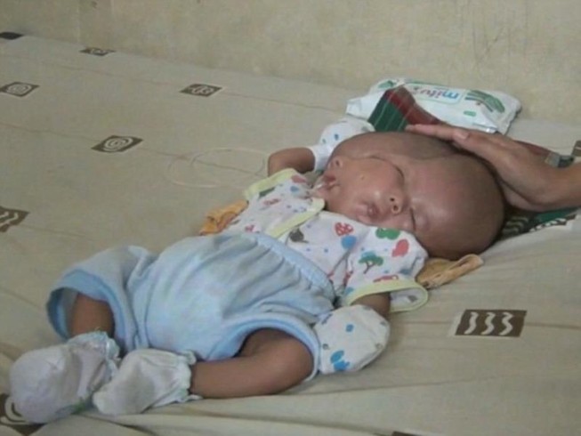 Bé trai sơ sinh có hai mặt, hai bộ não