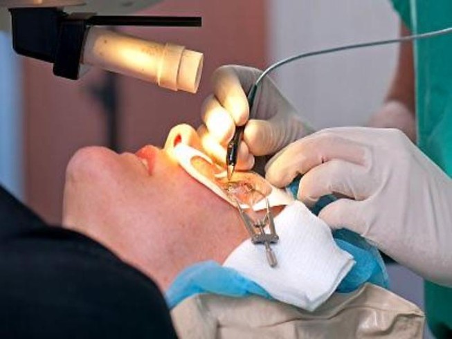 Có nên phẫu thuật chữa cận thị?
