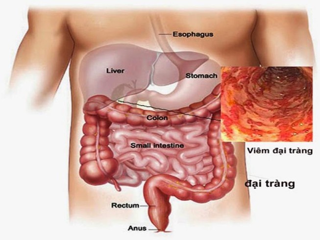 Những thực phẩm người bị viêm đại tràng mạn tính cần tránh