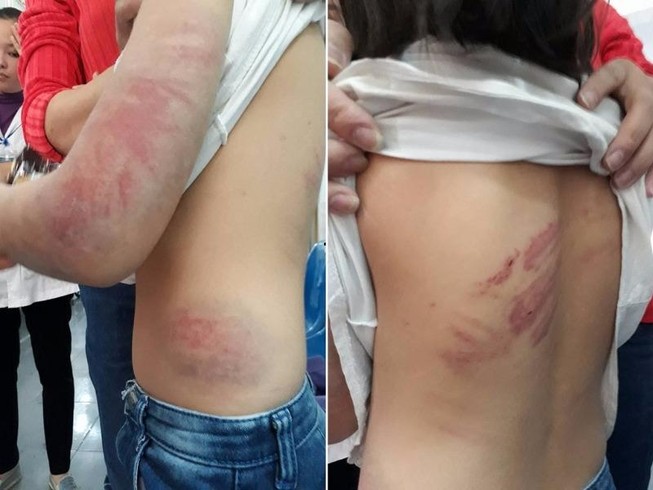 Bắt giam người cha đánh đập con gái 9 tuổi