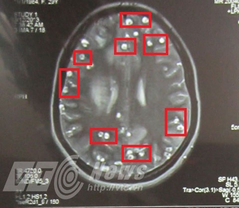 Ăn nem thính, tiết canh, bị sán lợn làm tổ dày đặc trong não
