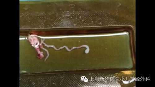 Sán dài 8 cm làm tổ trong não vì thức ăn đường phố