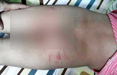 Bé ba tuổi bị đánh vì đi vệ sinh nhiều lần